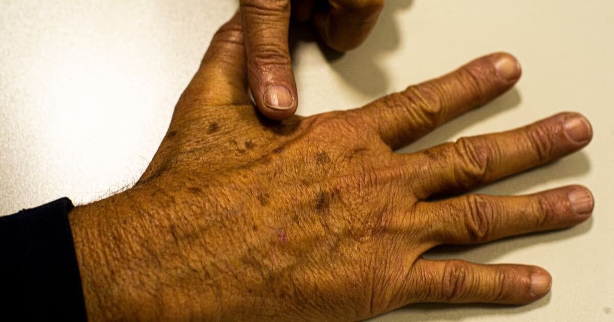 Câncer de Pele Lidera Diagnósticos em Brusque; Veja Outros Tipos Mais Registrados